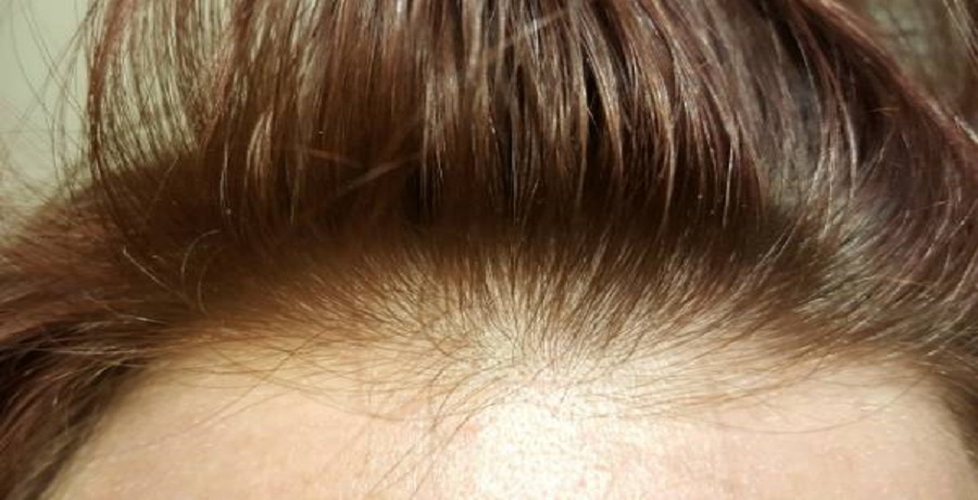 درمان ریزش موهای ارثی