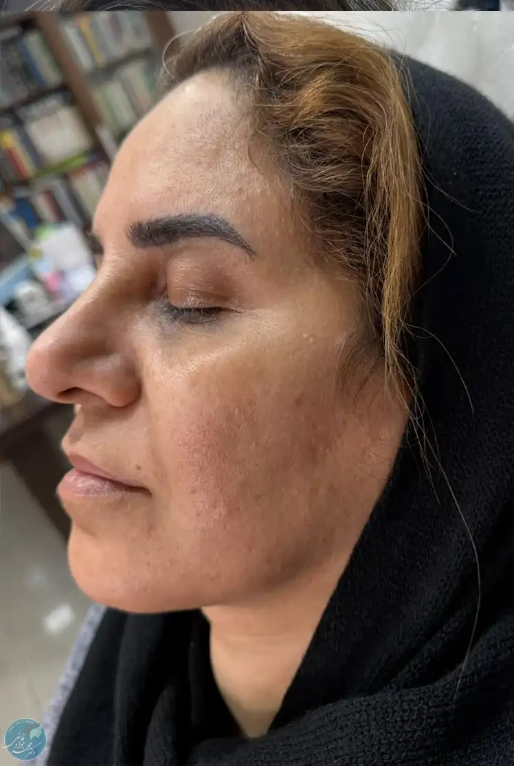 بعد از لیزر فوتونا