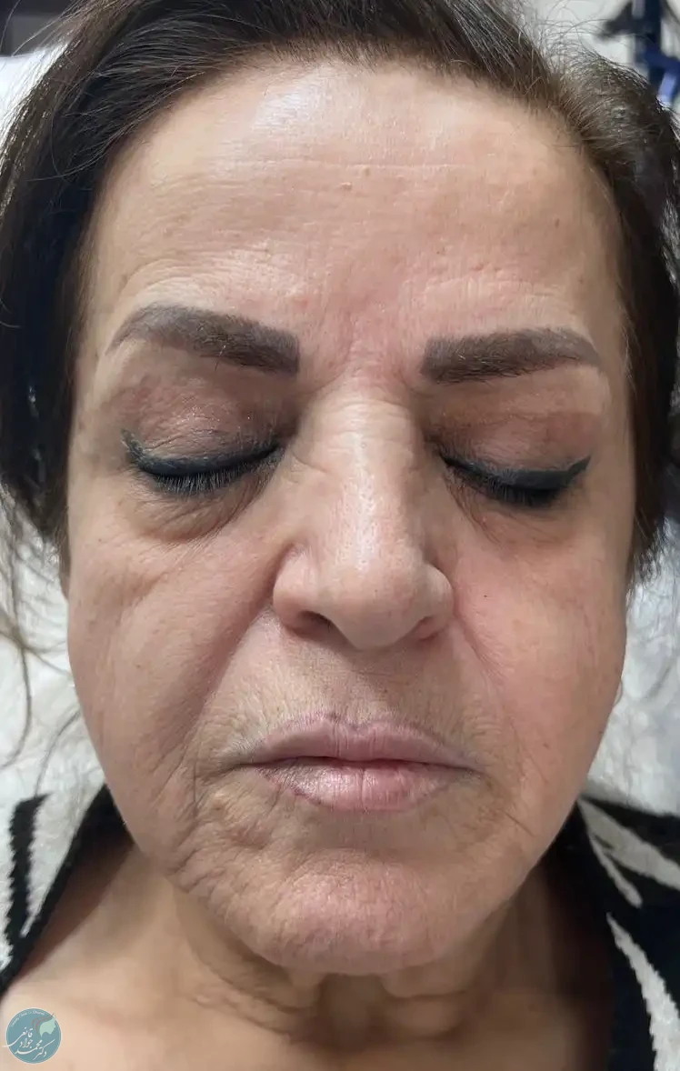 قبل از انجام فوتونا