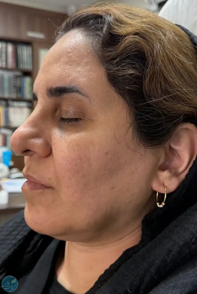 قبل از لیزر فوتونا