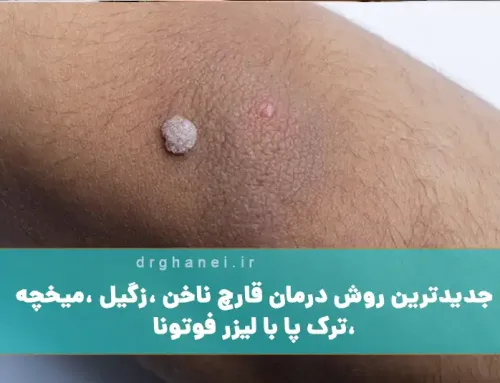 جدیدترین روش درمان قارچ ناخن، زگیل، میخچه، ترک پا با لیزر فوتونا