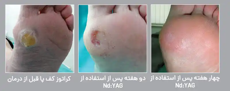 میخچه (Corns) و پینه (calluses)