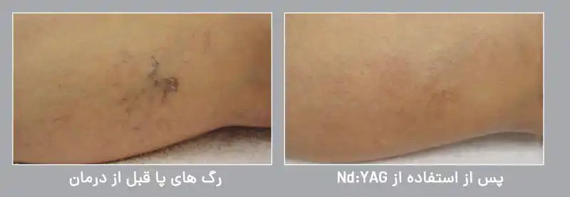 رگ های واریسی پا (Leg veins)