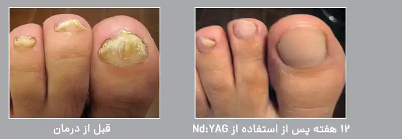 عفونت قارچی ناخن‌ها (Onychomycosis)