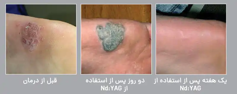 زگیل (Warts)