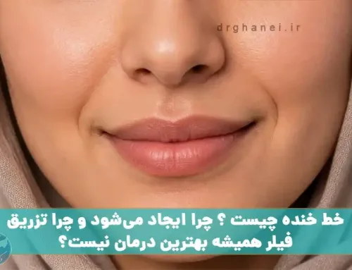 خط خنده چیست ؟ چرا ایجاد می‌شود و چرا تزریق فیلر همیشه بهترین درمان نیست؟
