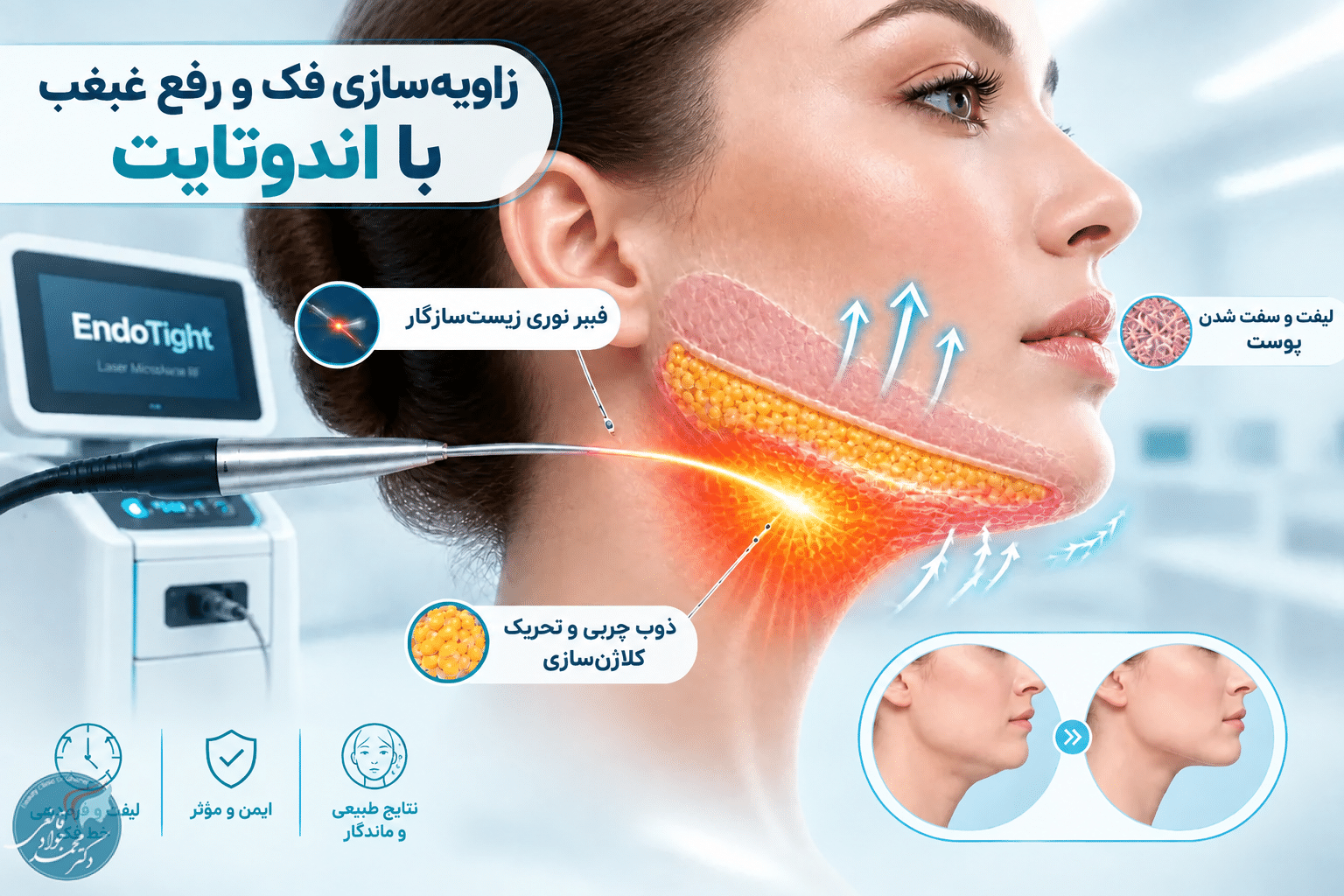 مکانیزم اثر اندوتایت با فیبر نوری در رفع چربی غبغب و کلاژنسازی خط فک