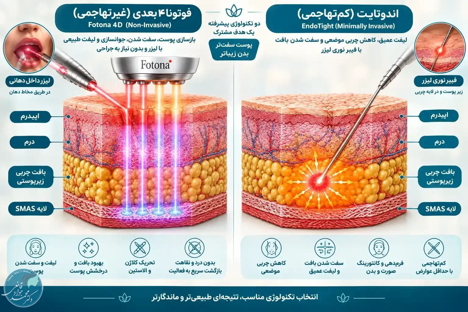 اینفوگرافیک مقایسه عمق نفوذ لیزر فوتونا ۴ بعدی و اندوتایت زیرپوستی در لایههای پوست